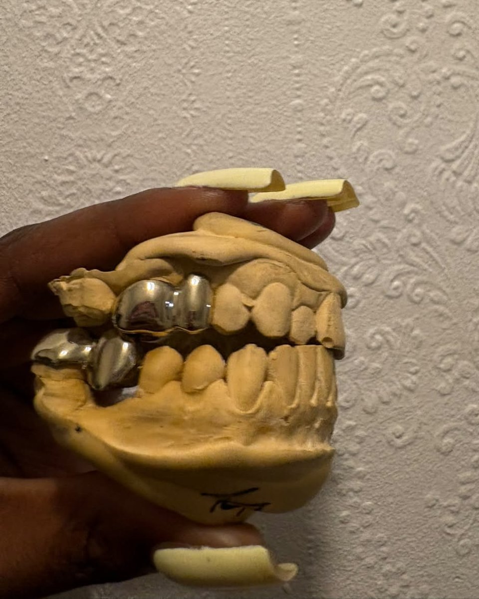 A finished set of polished caps sitting on a dental mould, held up against a textured wall